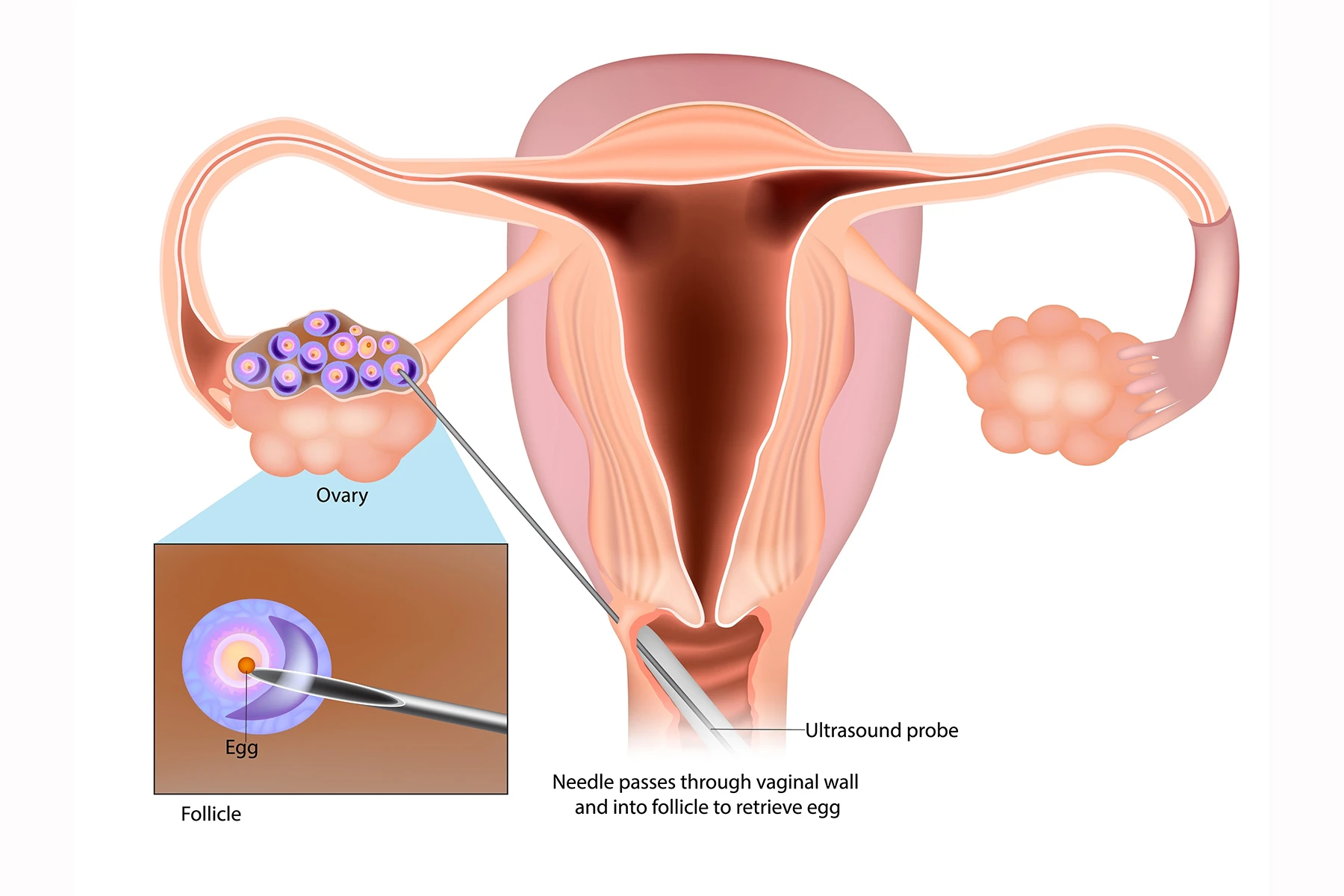 IVF Egg Retrieval technique. Egg retrieval procedure before in vitro fertilization